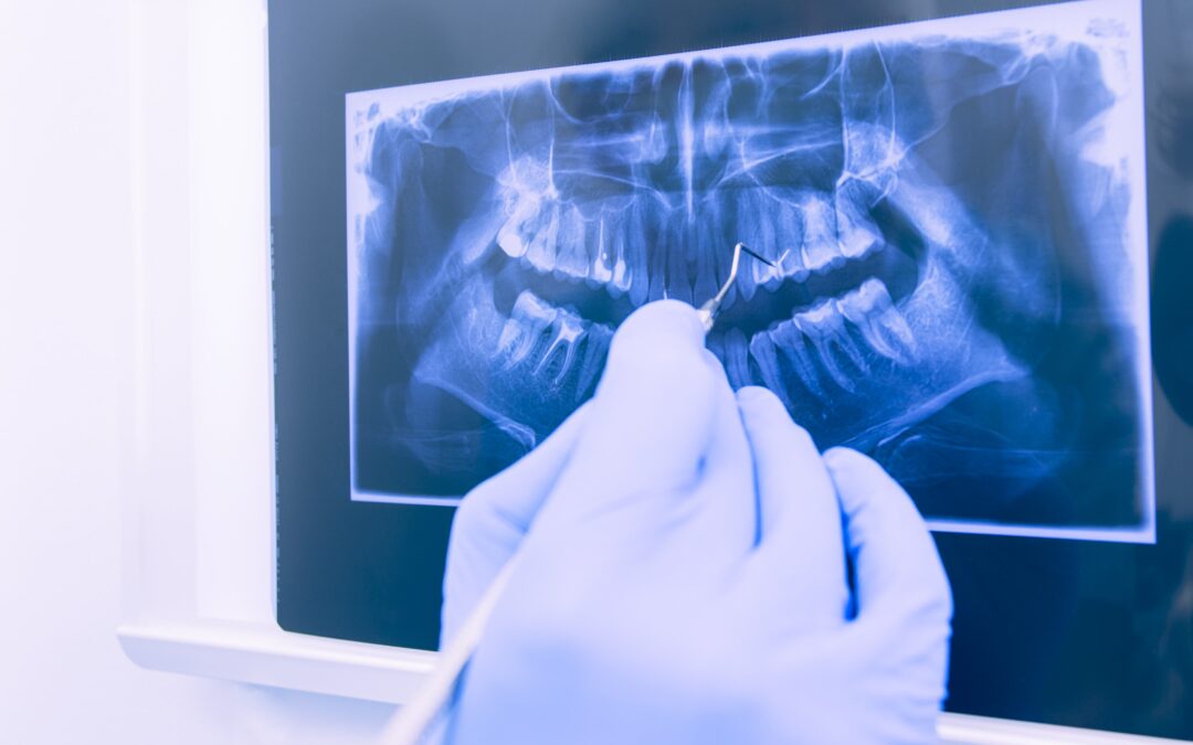 Impianti dentali zigomatici