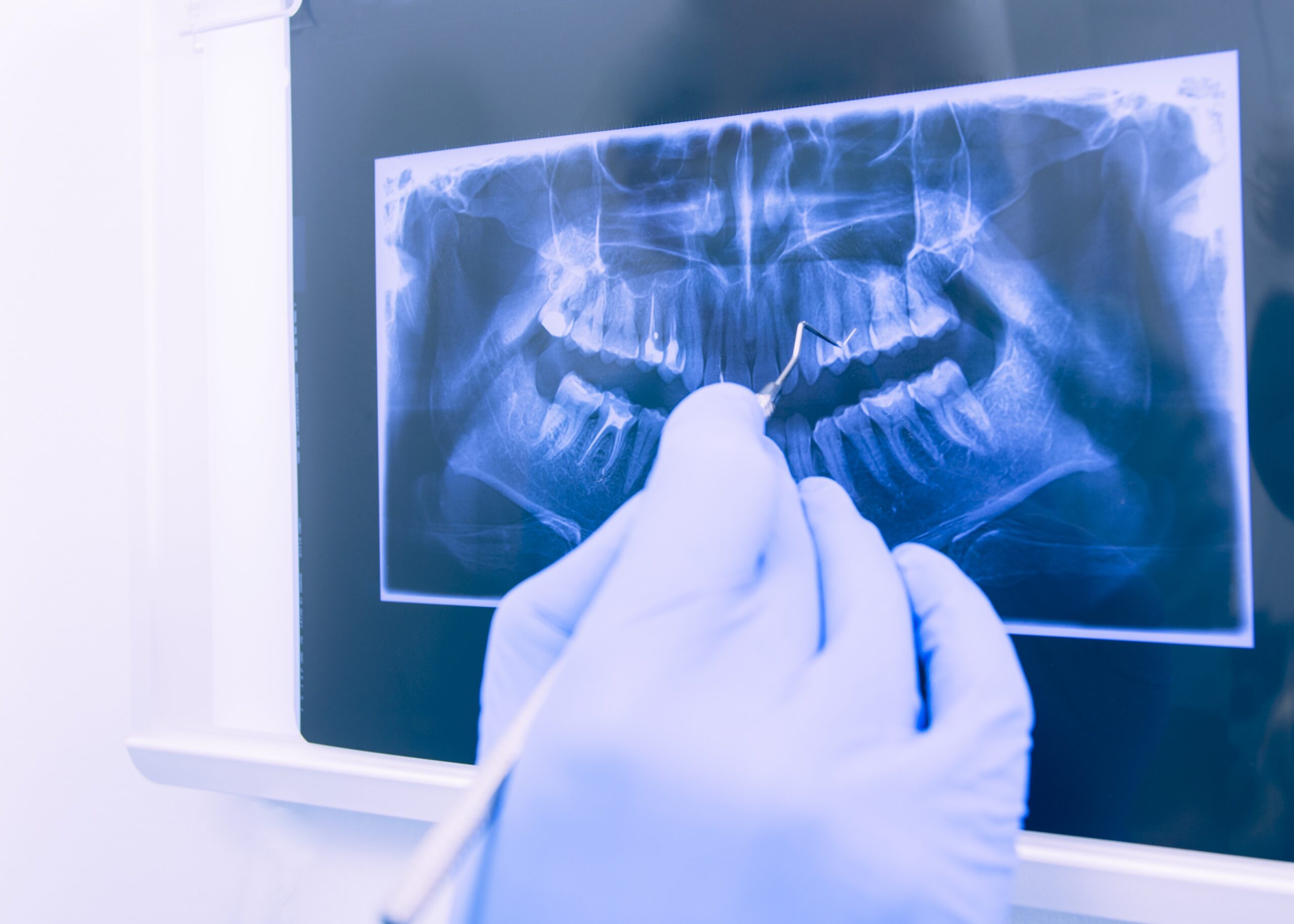 Impianti dentali zigomatici Impianti dentali zigomatici