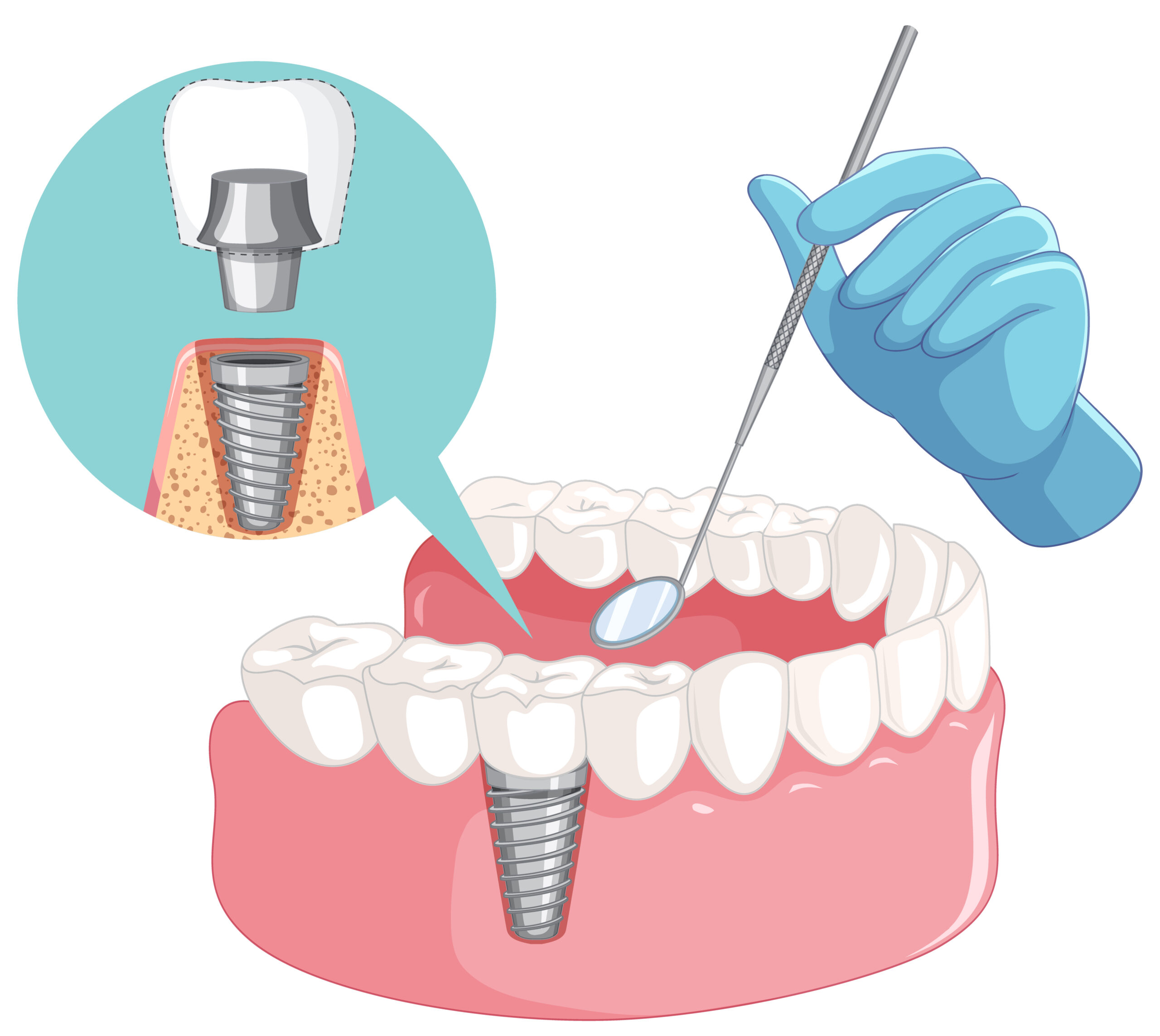 Implantologia Dentale Tutta La verità Implantologia Dentale Tutta La verità