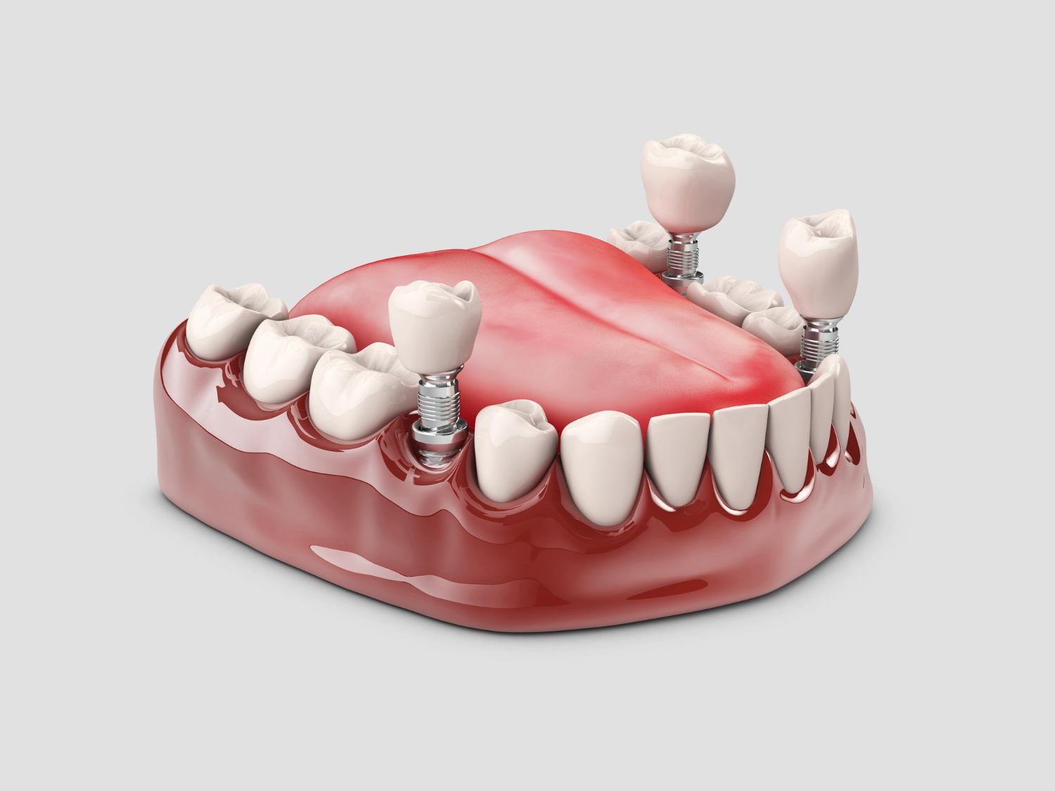 denti-umani-e-impianto-dentale-illustrazione-3d