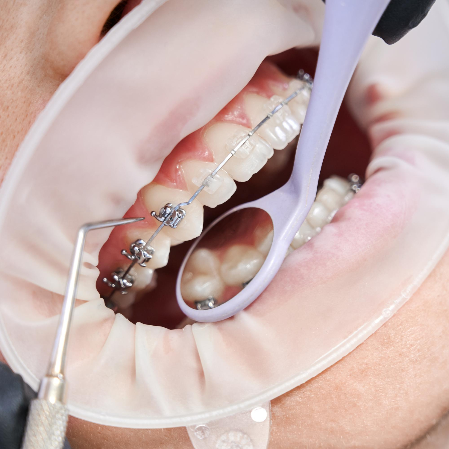 Dentista Allineamento Denti Acilia Ostia Casalpalocco Dentista Allineamento Denti Acilia Ostia Casalpalocco