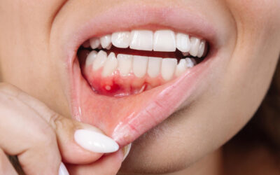 Gengiva gonfia intorno al dente: cosa può significare e come si cura?