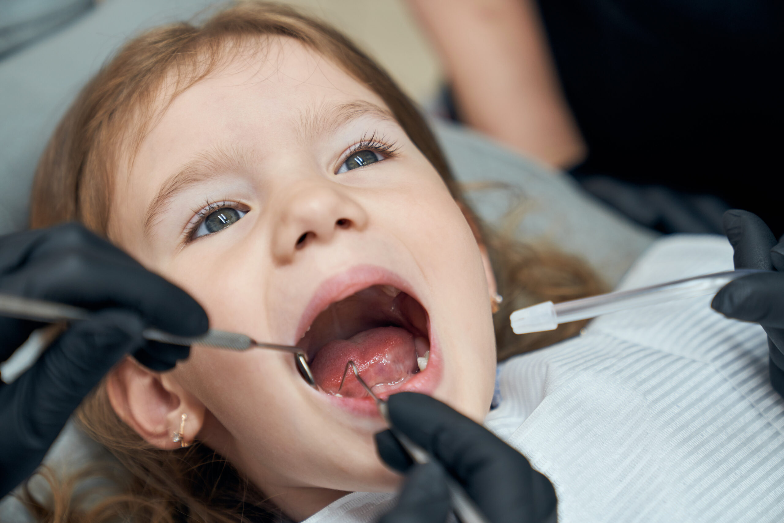 Cura della Carie Dentale nei Bambini molto piccoliCura della Carie Dentale nei Bambini molto piccoli Cura della Carie Dentale nei Bambini molto piccoli