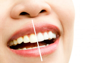 Le cause della decolorazione dei denti