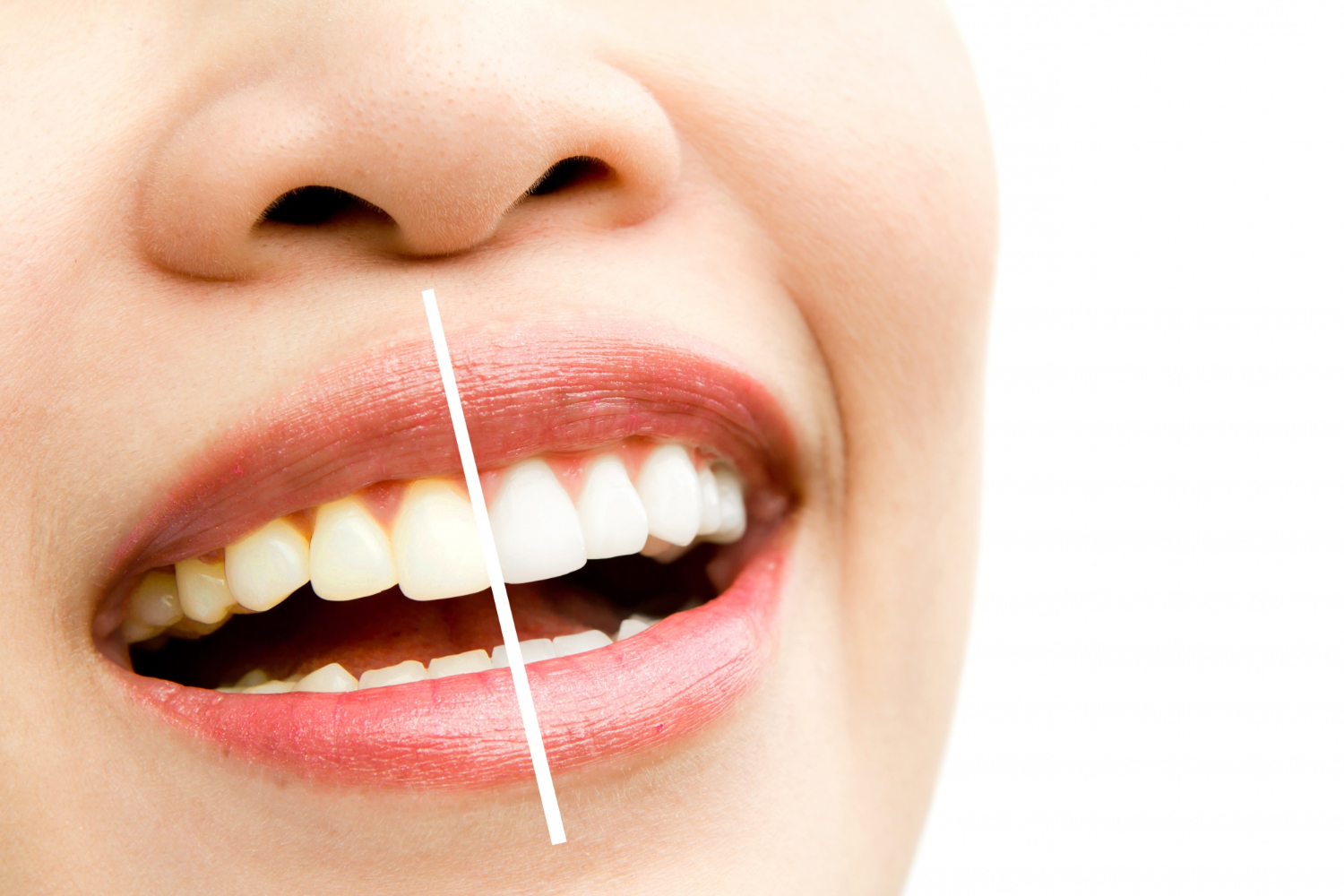 Decolorazione Dentale Decolorazione Dentale