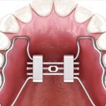 Espansione Rapida del Palato Stretto