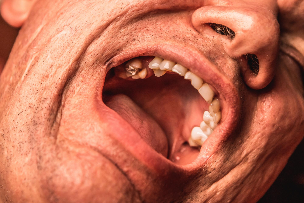 Usura dentale: come intervenire prima che sia troppo tardi