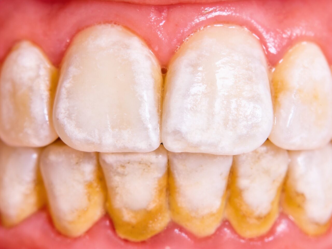 Placca Dentale Placca Dentale